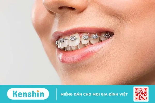 Răng lồi xỉ là gì, nguyên nhân và cách điều trị 4