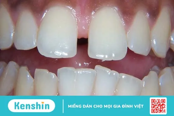 Răng sinh đôi: Nguyên nhân và cách khắc phục hiệu quả 1