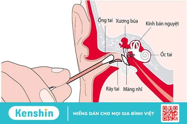 Ráy tai là gì, màu sắc ráy tai biểu thị bệnh lý gì? 1