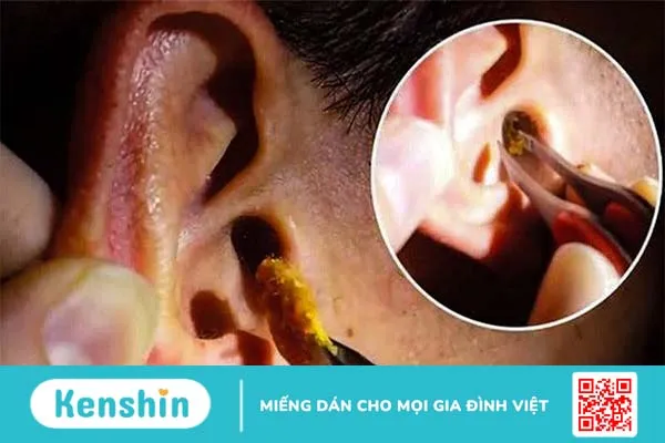 Ráy tai là gì, màu sắc ráy tai biểu thị bệnh lý gì? 2