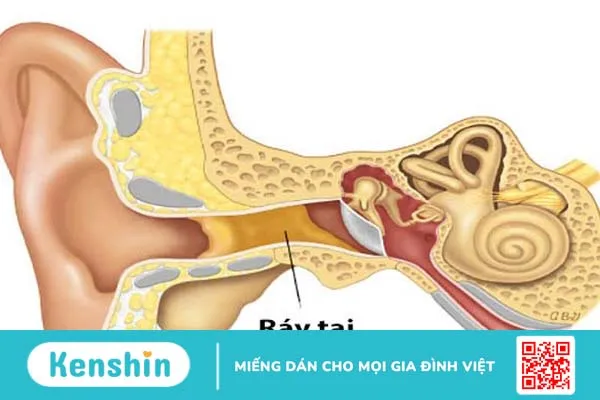 Ráy tai nhiều có bị sao không? 1