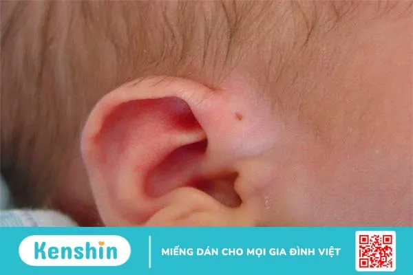 Rò luân nhĩ vệ sinh như thế nào? Các phương pháp điều trị 1