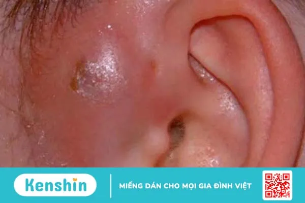 Rò luân nhĩ vệ sinh như thế nào? Các phương pháp điều trị 2