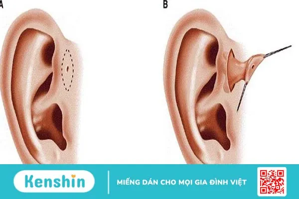 Rò luân nhĩ vệ sinh như thế nào? Các phương pháp điều trị