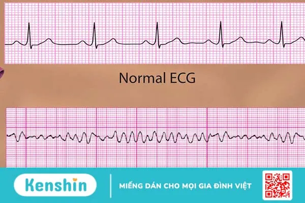 Rối loạn nhịp tim có nguy hiểm không? Một số dạng rối loạn nhịp tim thường gặp 3