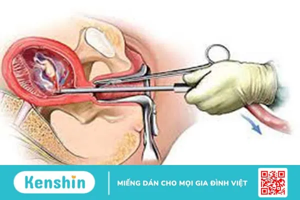 Hút thai là một thủ thuật ngoại khoa giúp phá thai bằng một loại ống chuyên dụng