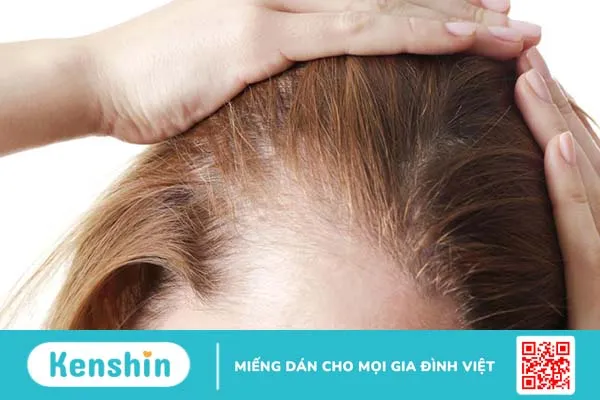 Rụng tóc Telogen là gì? Cách khắc phục tình trạng này 3