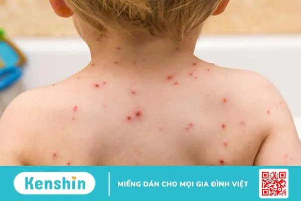 Thủy đậu do virus Varicella gây ra và dễ lây qua đường hô hấp