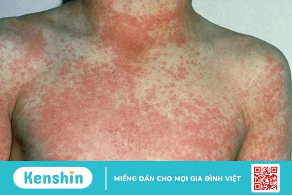 Scarlet fever là gì? Nguyên nhân, triệu chứng, chẩn đoán và điều trị Scarlet fever 1