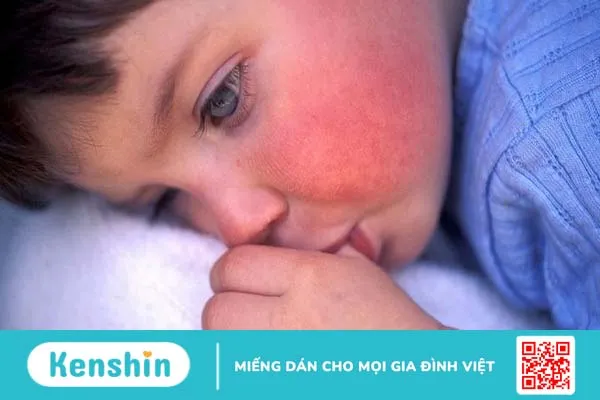 Scarlet fever là gì? Nguyên nhân, triệu chứng, chẩn đoán và điều trị Scarlet fever 4