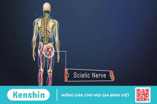 Sciatic nerve là gì? Nguyên nhân, triệu chứng và các phương pháp điều trị 1