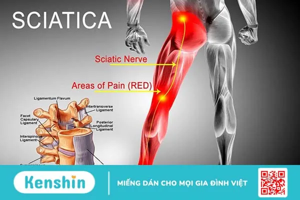 Sciatic nerve là gì? Nguyên nhân, triệu chứng và các phương pháp điều trị 2