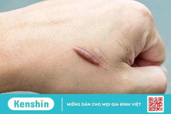 Sẹo lồi bị thâm: Nguyên nhân và cách khắc phục 1