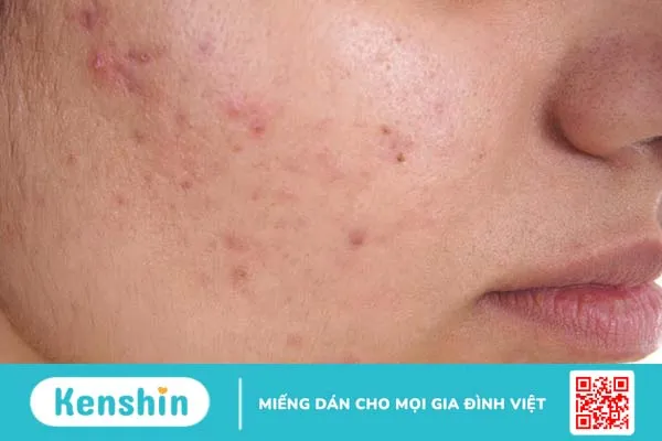 Sẹo lồi sau mụn: Nguyên nhân và cách điều trị 1