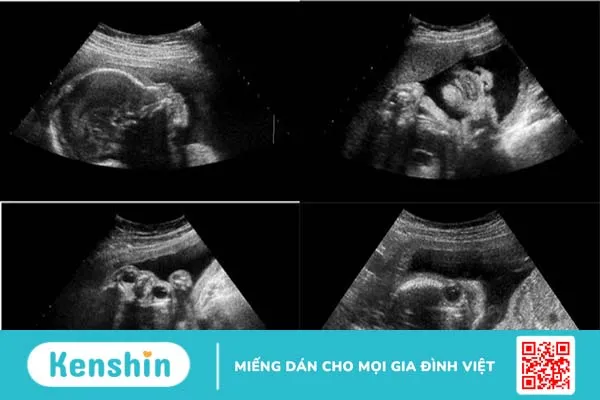 Siêu âm đầu dò: Những điều bạn cần biết 3