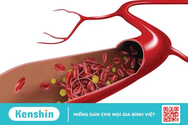 Siêu âm động mạch cảnh 3