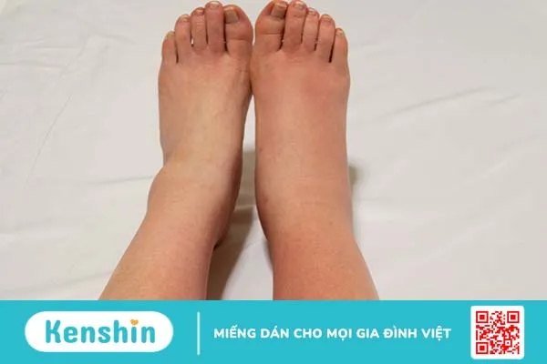 Siêu âm tĩnh mạch chi dưới, khi nào nên thực hiện? 2