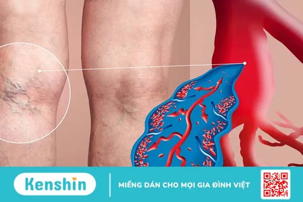 Siêu âm tĩnh mạch chi dưới, khi nào nên thực hiện? 3