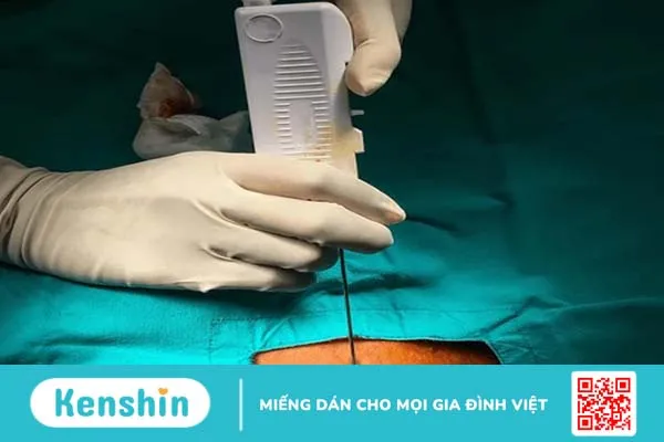 Sinh thiết là gì? Quá trình sinh thiết diễn ra như thế nào? 3