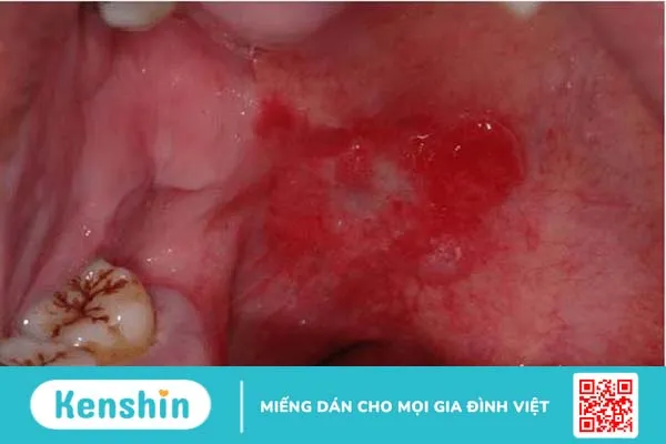 Soft palate là gì? Cấu tạo và chức năng của soft palate 4