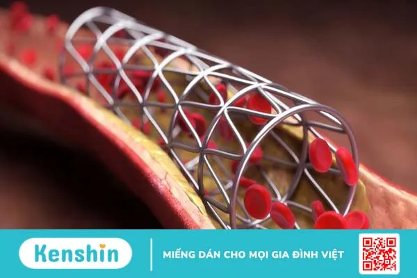 Những điều bạn nên biết về thủ thuật đặt stent mạch vành 1