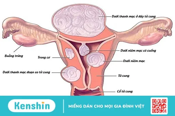 Sự nguy hiểm của tình trạng u xơ tử cung bị vôi hóa 1