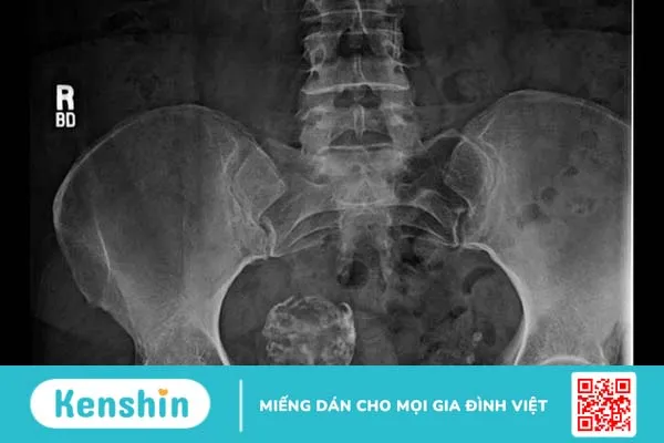 Sự nguy hiểm của tình trạng u xơ tử cung bị vôi hóa 5