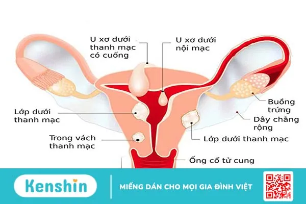 Sự tác động giữa u xơ tử cung và thai nghén 1