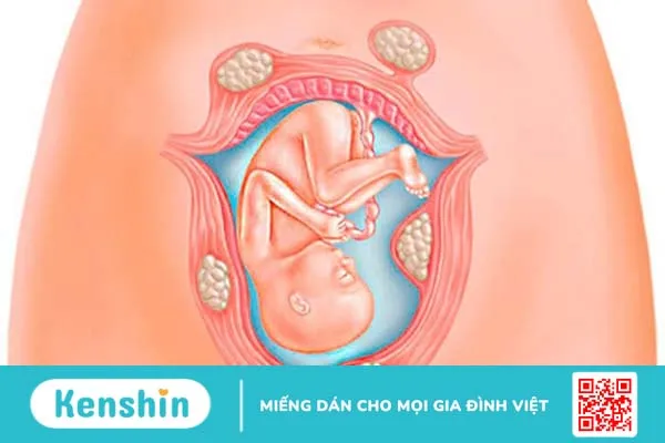 Sự tác động giữa u xơ tử cung và thai nghén 3