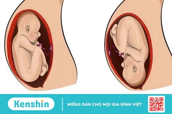 Sự tác động giữa u xơ tử cung và thai nghén 4