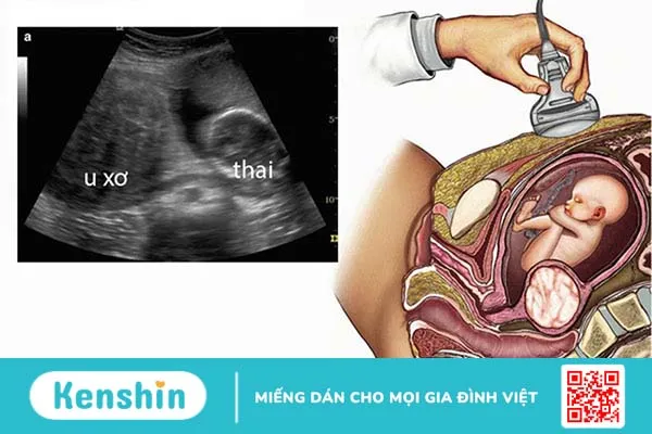 Sự tác động giữa u xơ tử cung và thai nghén 5