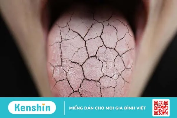 Sưng lưỡi là bệnh gì? Nguyên nhân và cách điều trị