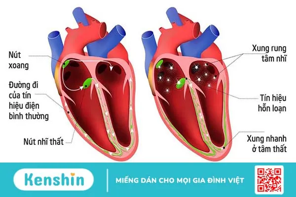 Suy nút xoang tim: Nguyên nhân, chẩn đoán và phương pháp điều trị 1