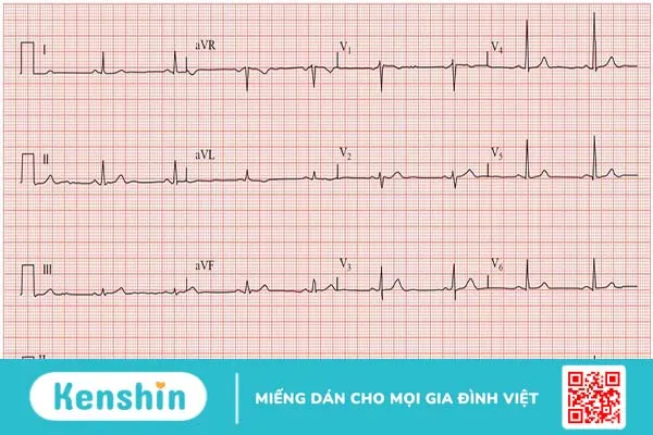 Suy nút xoang tim: Nguyên nhân, chẩn đoán và phương pháp điều trị 3