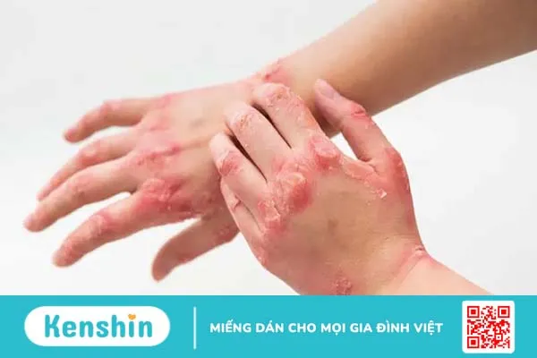 Tác động của các yếu tố tâm lý đối với bệnh viêm khớp vảy nến 1