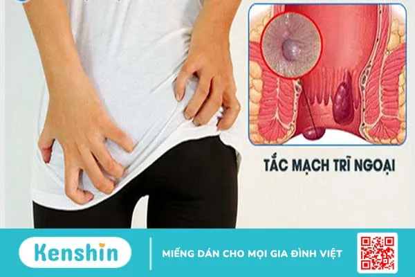 Tác hại của bệnh trĩ mà bạn nên biết 3