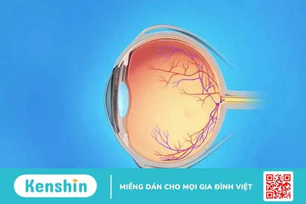 Tắc tĩnh mạch trung tâm võng mạc do nguyên nhân gì? Cách điều trị và phòng tránh 1