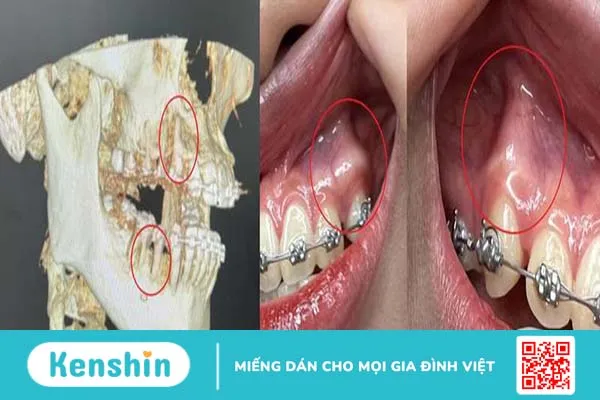 Bật chân răng ảnh hưởng như thế nào? -1