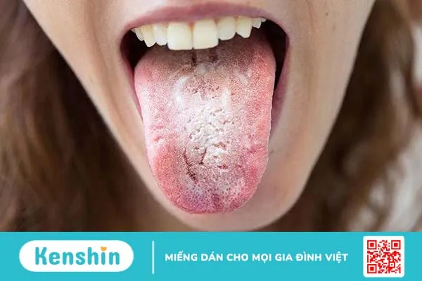 Tại sao nấm họng gây ho? Nguyên nhân và cách điều trị ra sao 1