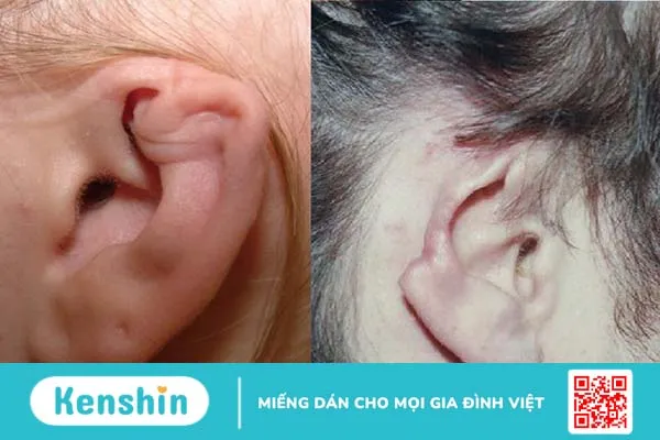 Tại sao nên bôi thuốc mỡ sau khi bấm lỗ tai?