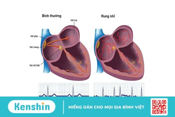 Tâm nhĩ là gì? Các bệnh lý thường gặp ở tâm nhĩ 2