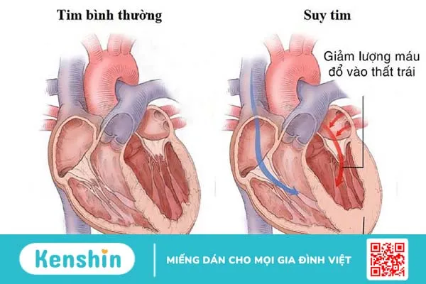 Tâm thất là gì? Các vấn đề sức khỏe thường gặp ở tâm thất  2