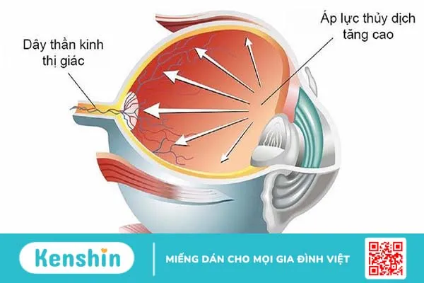 Tăng huyết áp mắt: Nguyên nhân và cách điều trị 1