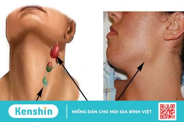 Tăng sản hạch bạch huyết: Nguyên nhân, triệu chứng, biến chứng và cách chữa trị 1