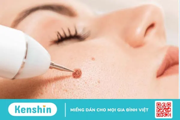 Tẩy nốt ruồi có ăn được thịt lợn không? 2