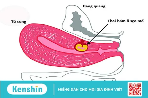 Thai bám vào vết mổ tử cung là gì? 1