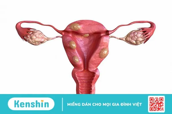 Thận trọng với biến chứng rò niệu quản sau cắt u xơ tử cung 2