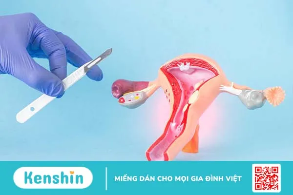 Thận trọng với biến chứng rò niệu quản sau cắt u xơ tử cung 4