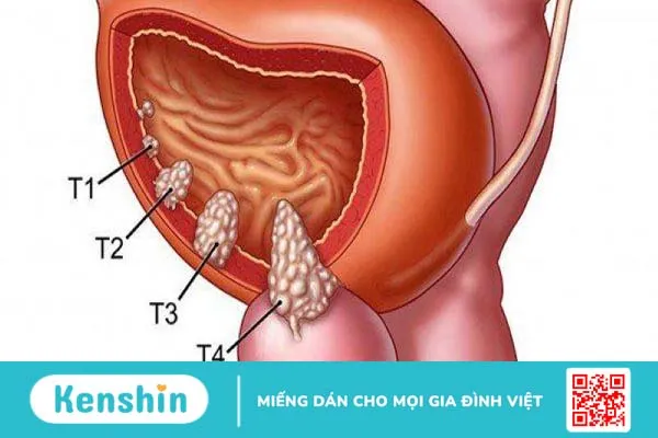 Thang điểm Gleason là gì? Những thông tin cần biết về ung thư tuyến tiền liệt 1