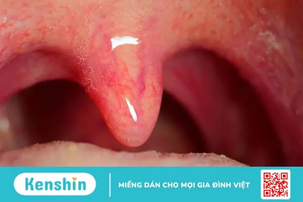 Viêm họng lưỡi gà dài, bạn đã hiểu rõ hay chưa?